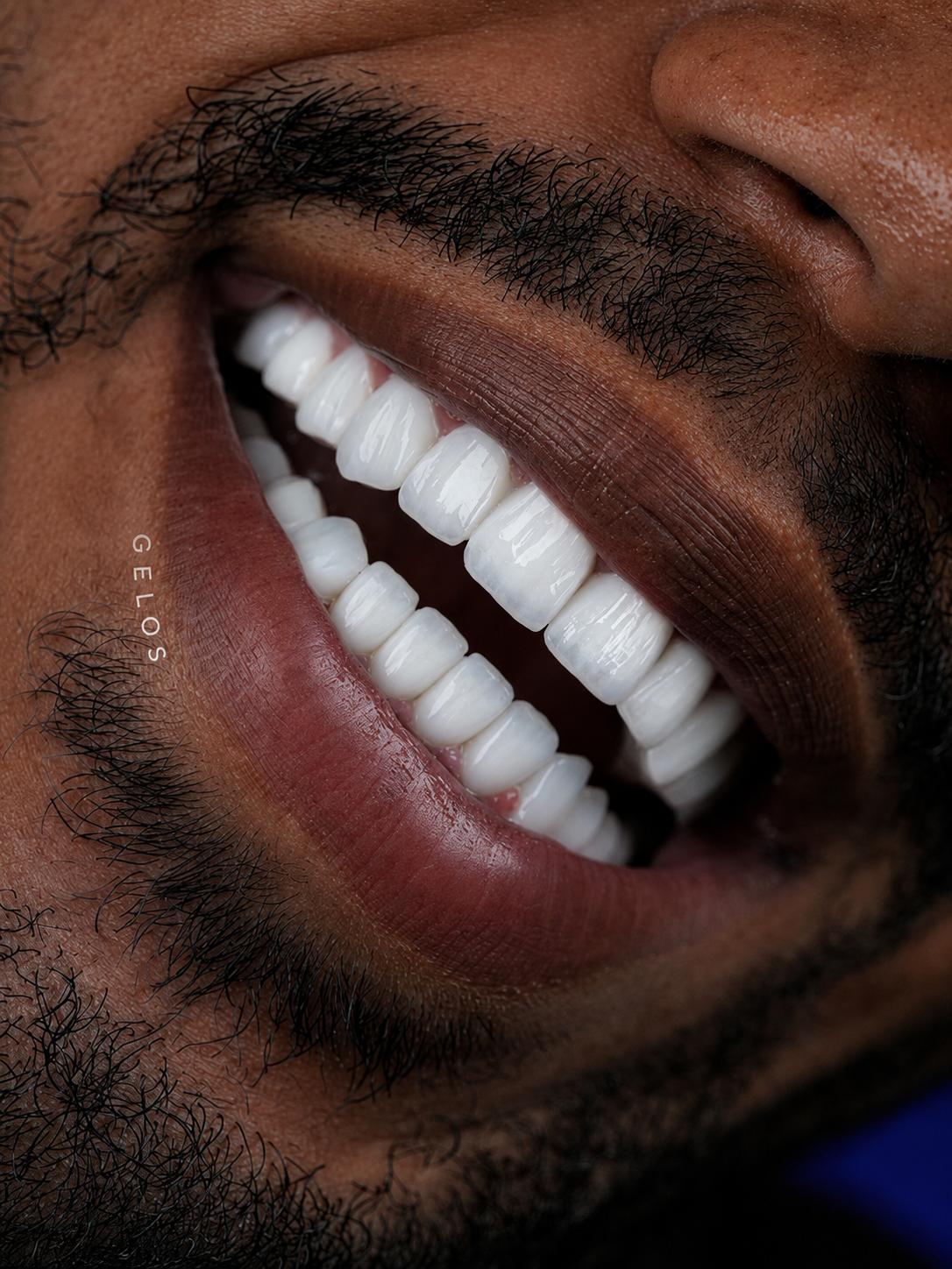 Teeth Whiteners
